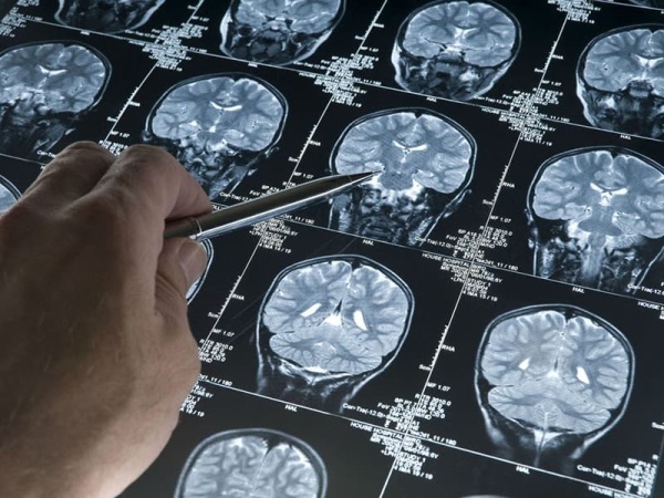 Research at the Rush Alzheimer’s Disease Center. 